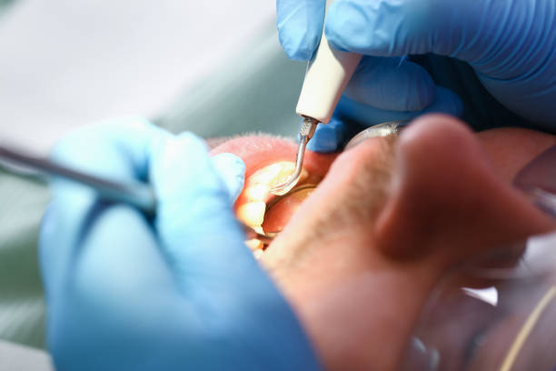 Best Chipped Tooth Repair Near Me  in Willow Grove, TX